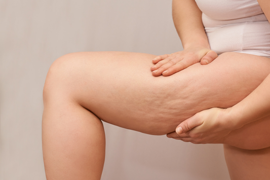 Kako se znebiti celulita?